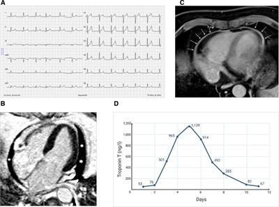 Case report: mRNA-1273 COVID-19 vaccine-associated myopericarditis: Successful treatment and re-exposure with colchicine